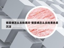 银屑病怎么去除黑印 银屑病怎么去除黑色素沉淀