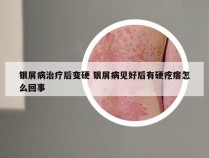 银屑病治疗后变硬 银屑病见好后有硬疙瘩怎么回事