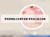 梦见老娘身上长满牛皮癣 梦见女人身上长癣