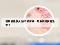 银屑病能多久治好 银屑病一般多长时间就治好了