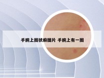 手腕上圈状癣图片 手腕上有一圈