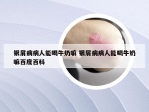 银屑病病人能喝牛奶嘛 银屑病病人能喝牛奶嘛百度百科