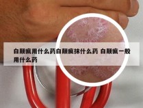 白颠疯用什么药白颠疯抹什么药 白颠疯一般用什么药