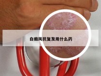 白癜风抗复发用什么药