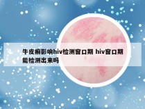 牛皮癣影响hiv检测窗口期 hiv窗口期能检测出来吗