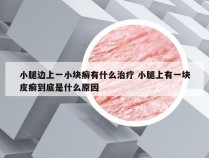 小腿边上一小块癣有什么治疗 小腿上有一块皮癣到底是什么原因