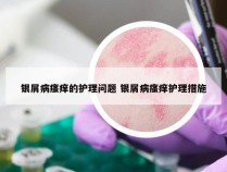 银屑病瘙痒的护理问题 银屑病瘙痒护理措施