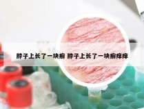 脖子上长了一块癣 脖子上长了一块癣痒痒