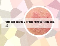 银屑病皮屑没有了但很红 银屑病不起皮就是红