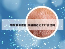 银屑病会进化 银屑病进化工厂合适吗