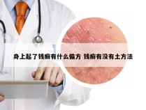 身上起了钱癣有什么偏方 钱癣有没有土方法