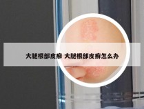 大腿根部皮癣 大腿根部皮癣怎么办