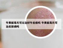 牛黄解毒片可以治好牛皮癣吗 牛黄解毒片可治皮肤病吗