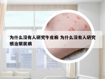 为什么没有人研究牛皮癣 为什么没有人研究根治银屑病