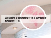 通化治疗银屑病医院哪家好 通化治疗银屑病医院哪家好一点