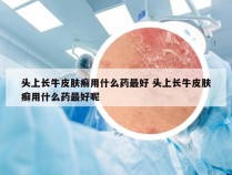 头上长牛皮肤癣用什么药最好 头上长牛皮肤癣用什么药最好呢