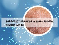 小孩冬天起了好多癣怎么办 孩子一到冬天就长皮癣怎么回事?