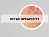 癣吃什么药 癣吃什么药治好得快