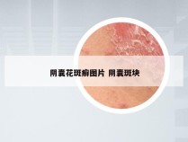 阴囊花斑癣图片 阴囊斑块