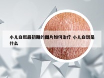 小儿白斑最初期的图片如何治疗 小儿白斑是什么