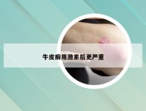 牛皮癣用激素后更严重