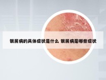 银屑病的具体症状是什么 银屑病是哪些症状