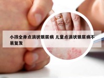 小孩全身点滴状银屑病 儿童点滴状银屑病不易复发