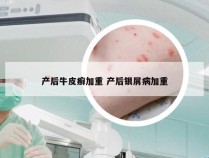 产后牛皮癣加重 产后银屑病加重