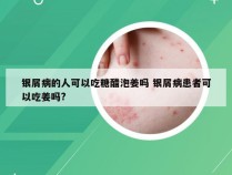 银屑病的人可以吃糖醋泡姜吗 银屑病患者可以吃姜吗?