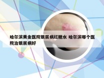 哈尔滨黄金医院银屑病红糖水 哈尔滨哪个医院治银屑病好