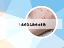 牛皮癣怎么治疗给多钱