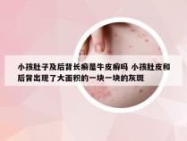 小孩肚子及后背长癣是牛皮癣吗 小孩肚皮和后背出现了大面积的一块一块的灰斑