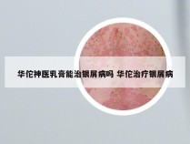 华佗神医乳膏能治银屑病吗 华佗治疗银屑病