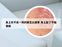 身上长干皮一样的癣怎么回事 身上起了干燥像癣