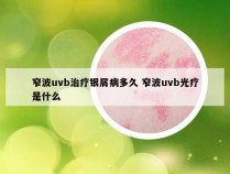 窄波uvb治疗银屑病多久 窄波uvb光疗是什么