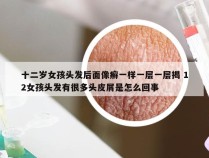 十二岁女孩头发后面像癣一样一层一层揭 12女孩头发有很多头皮屑是怎么回事