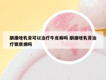 酮康唑乳膏可以治疗牛皮癣吗 酮康唑乳膏治疗银屑病吗