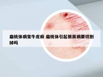 扁桃体病变牛皮癣 扁桃体引起银屑病要切割掉吗