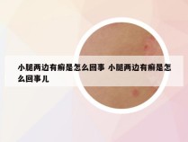 小腿两边有癣是怎么回事 小腿两边有癣是怎么回事儿