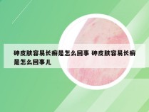 砷皮肤容易长癣是怎么回事 砷皮肤容易长癣是怎么回事儿