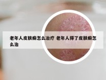 老年人皮肤癣怎么冶疗 老年人得了皮肤癣怎么治