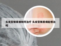 头皮型银屑病如何治疗 头皮型银屑病能根治吗