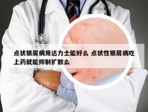 点状银屑病用达力士能好么 点状性银屑病吃上药就能抑制扩散么