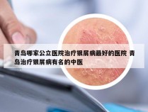 青岛哪家公立医院治疗银屑病最好的医院 青岛治疗银屑病有名的中医