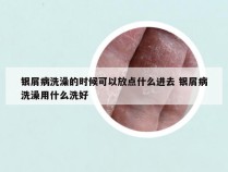 银屑病洗澡的时候可以放点什么进去 银屑病洗澡用什么洗好