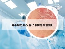 得手癣怎么办 得了手癣怎么治能好