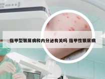 指甲型银屑病和内分泌有关吗 指甲性银屑病