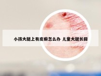 小孩大腿上有皮癣怎么办 儿童大腿长藓