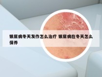 银屑病冬天发作怎么治疗 银屑病在冬天怎么保养