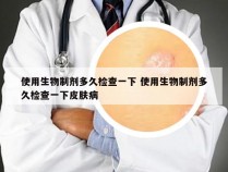 使用生物制剂多久检查一下 使用生物制剂多久检查一下皮肤病